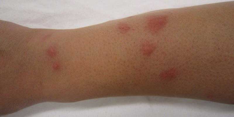 arm of an oakham lady bitten by bed bugs